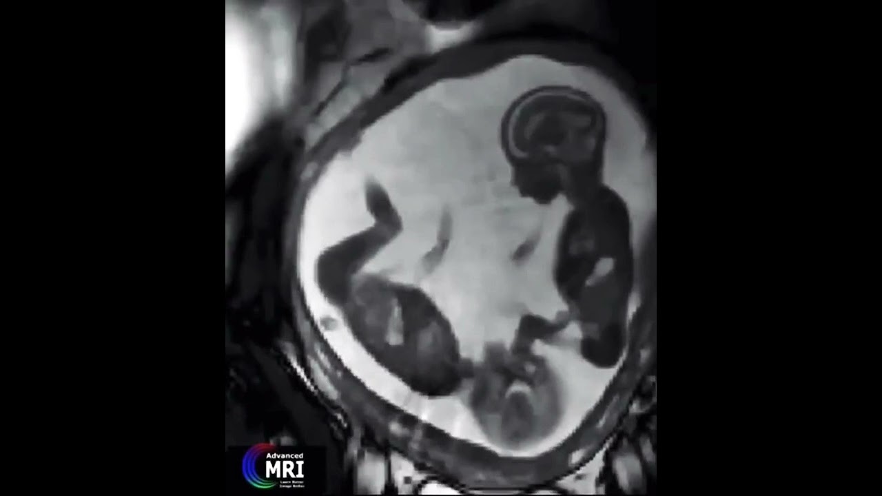 Unborn Twins fighting caught on Video MRI 😂