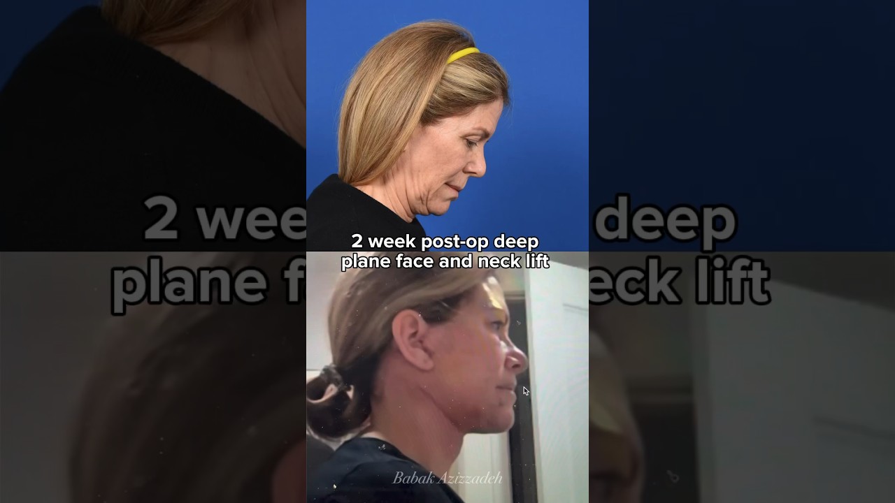 2 weeks post-op deep plane face and neck lift 