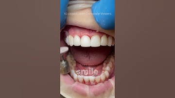 10 Upper and lower composite veneers #shorts
