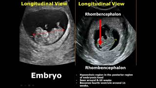 First Trimester & Ectopic Pregnancy Ultrasound Image Appearances