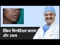 All About Skin Pigmentation (स्किन पिगमेंटेशन कारण और उपाय) | ClearSkin, Pune | (In HINDI)