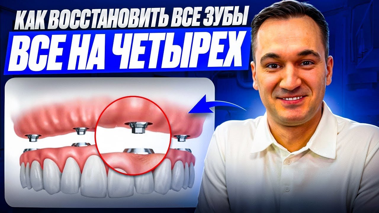 ЛУЧШИЙ ВАРИАНТ ВОССТАНОВЛЕНИЯ ЗУБОВ И ПОЛУЧИТЬ ИДЕАЛЬНУЮ УЛЫБКУ! ВСЕ НА 4 ИЛИ ALL IN 4