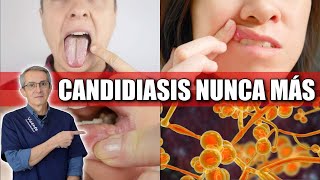 CURA DEFINITIVA para el hongo CANDIDA: ¡sorprendente y natural!