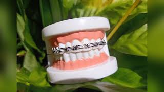 Cara pasang karet sambung spasi// karet power chain spasi // gaya gigi imut 😍😍😍😍😍 screenshot 2