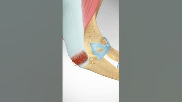 Triceps Tendon Avulsion and Surgical Repair #triceps #weightlifting