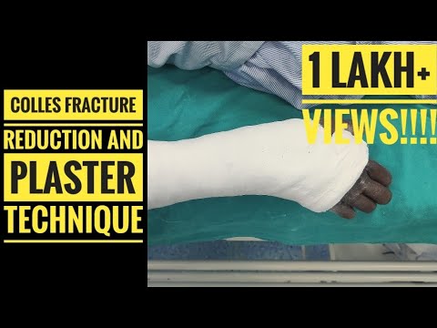 Colles Fracture Reduction and Plaster Technique 