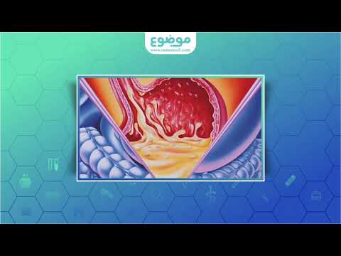 ما هي حموضة المعدة؟