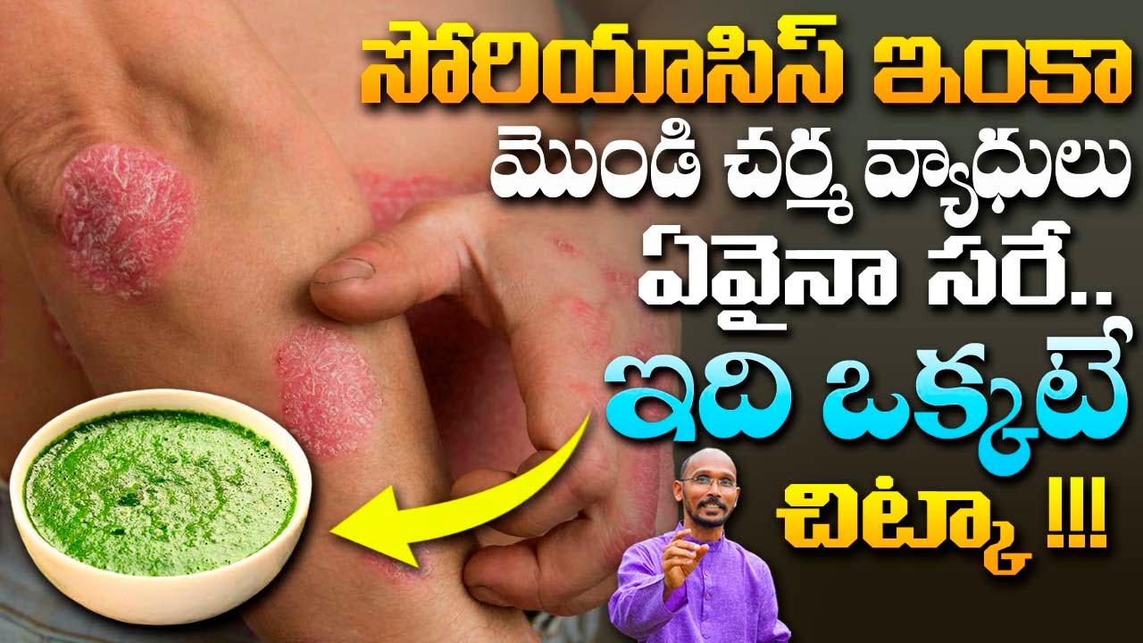 సోరియాసిస్ ఇంకా మొండి చర్మ వ్యాద్యులు ఏవైనా సరే ఇది ఒక్కటే చిట్కా | Dr. Madhu Babu | Health Trends |