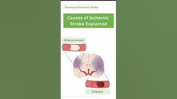 Causes of Ischemic Stroke Explained 🧠