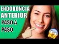 ENDODONCIA EN EL DIENTE DELANTERO- ME ROMPÍ UN DIENTE -COMO ES UNA ENDODONCIA?- COMO M@TAR EL NERVIO