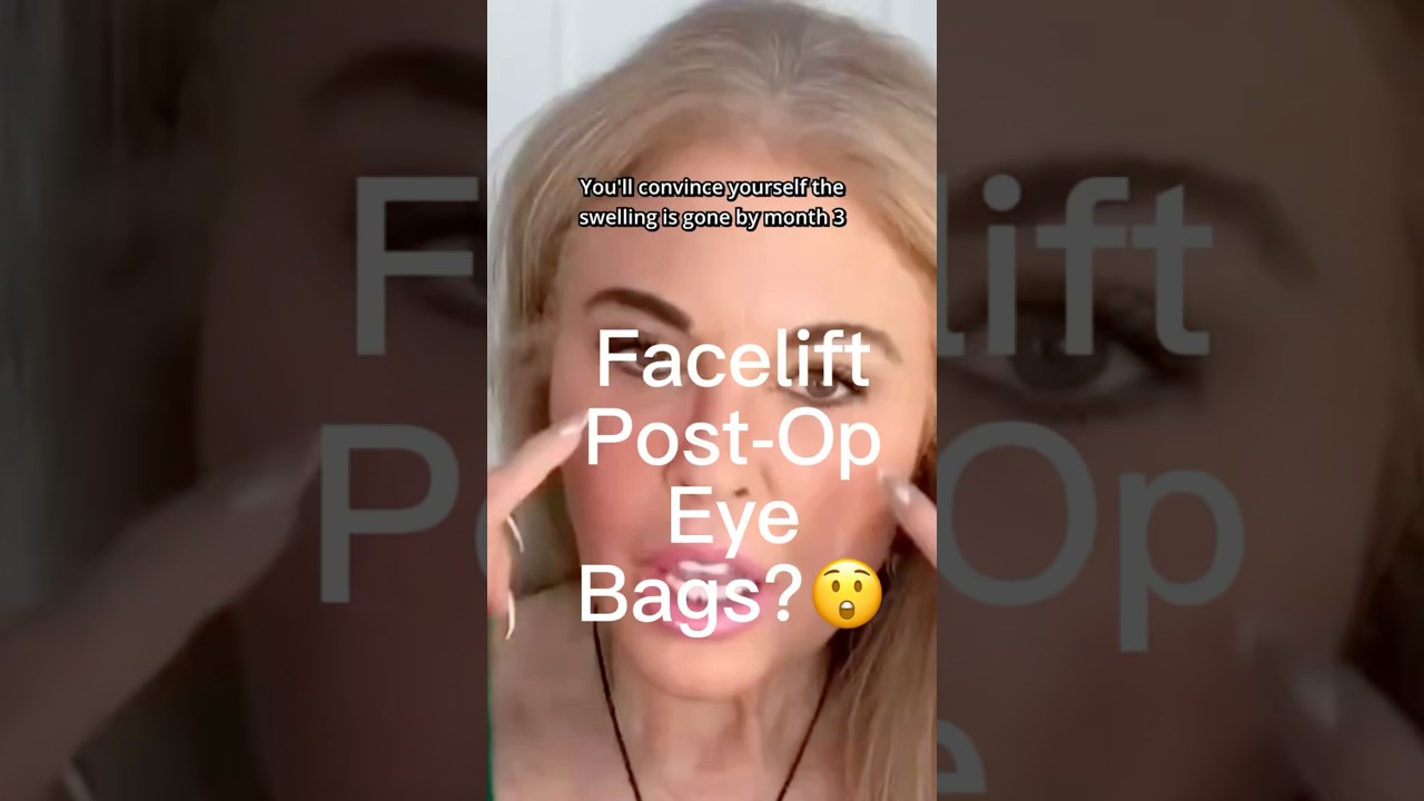 Facelift Post-Op Eye Bags? 😲