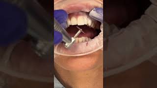 45 seconds of dentistry #shorts