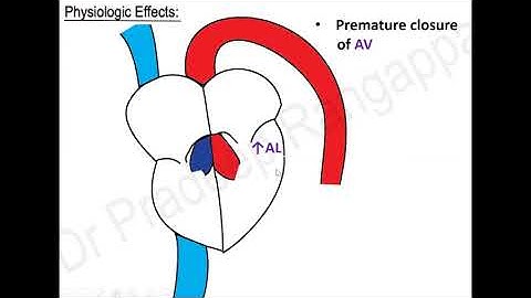IABP | Dr. Pradeep Rangappa