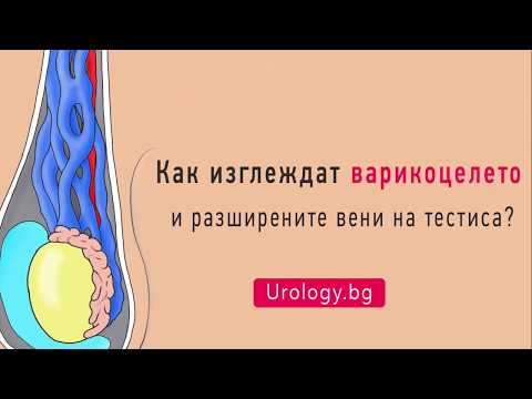 Как изглежда варикоцелето?