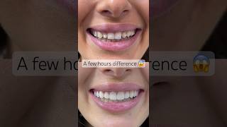 Composite bonding before vs after 😱 Beautiful work by Dr. Sonnie #newsmile #dentistrylove