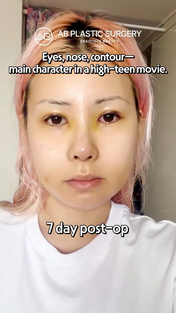 She Looks Completely Different After Korean Surgery #shorts
