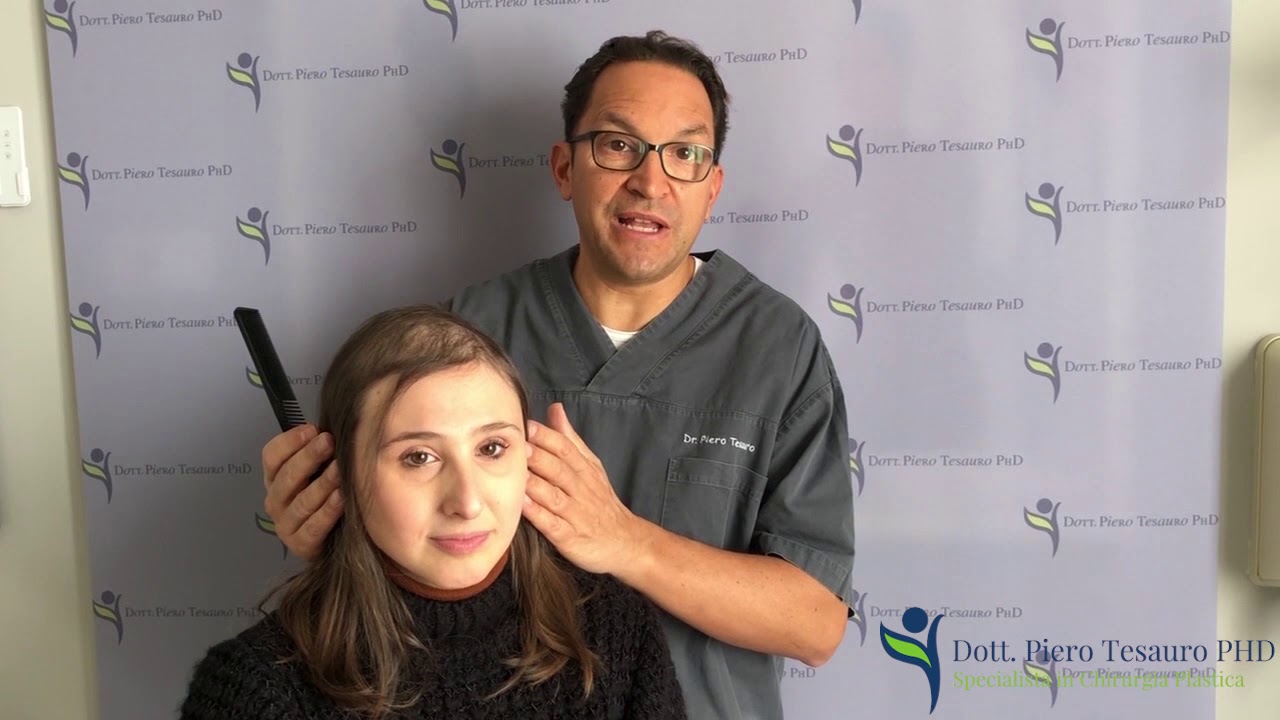 Dott. Piero Tesauro | Autotrapianto di capelli ricostruttivo