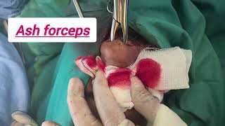 Comminuted nasal fracture 