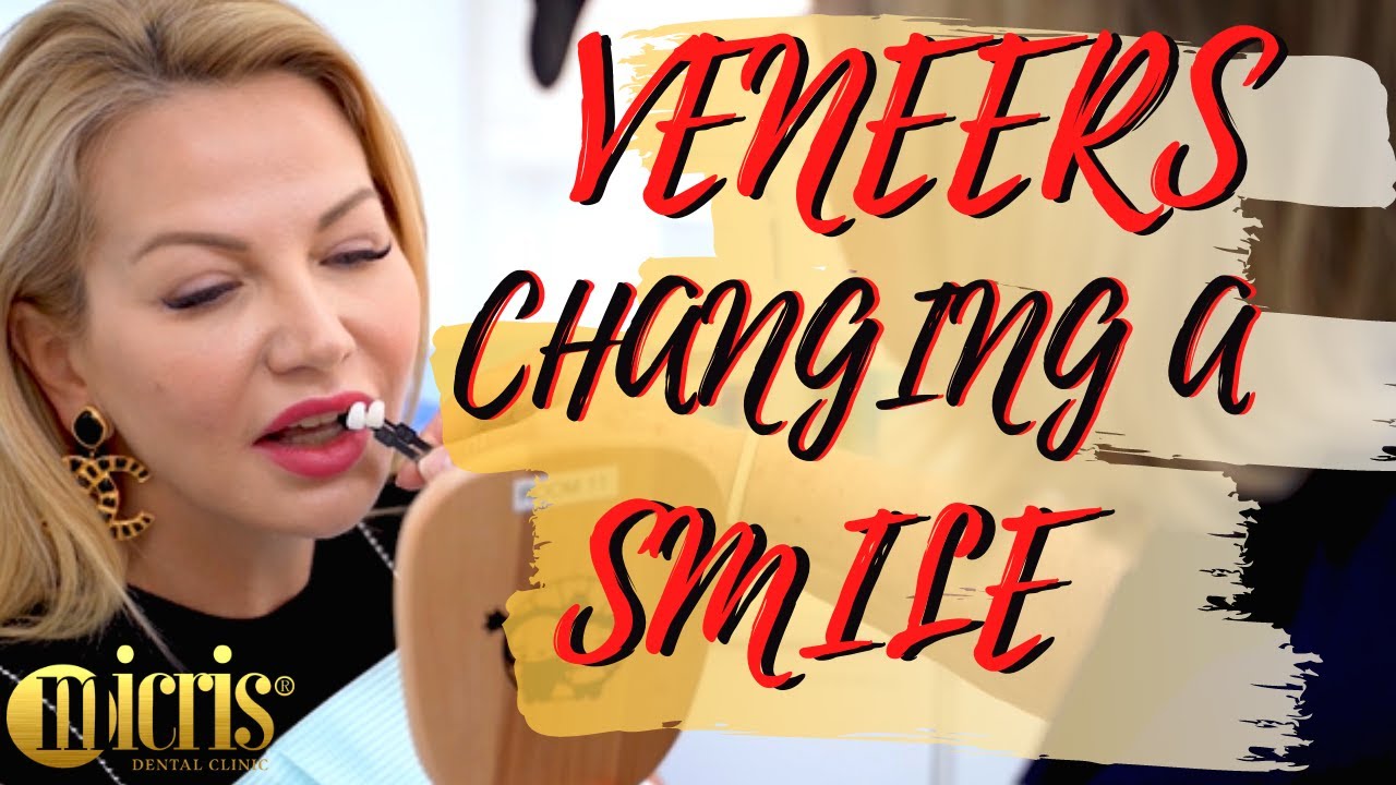 Veneers Changing a Smile | A Smile Makeover With Veneers In Dubai | Patient Testimonial