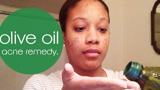 olive oil for acne prone skin