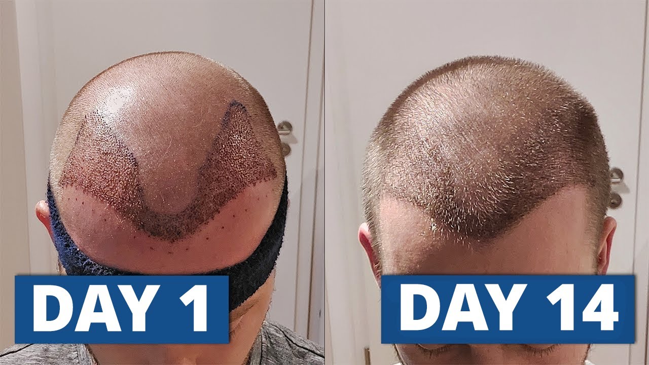 1 14 Days After Hair Transplant The Complete Healing Process YouTube
