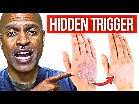 WHY Your ECZEMA Keeps Coming BACK (And How To FIX IT)