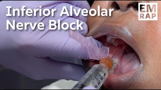 Inferior Alveolar Nerve Block