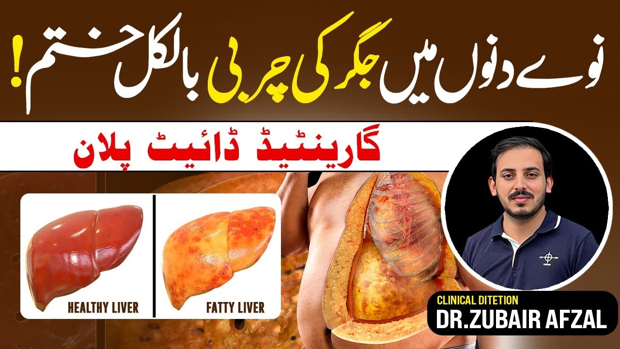 Treat Your Fatty Liver Only in 90 Days | Lose Liver Fat Easily With This Diet by Dr. Zubair Afzal