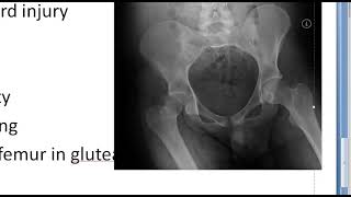 Orthopedics 149 Posterior Dislocation hip Dashboard injury Avascular necrosis Myositis ossificans