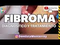 🤔 Qué ES❓Un FIBROMA👅Diagnóstico y TRATAMIENTO