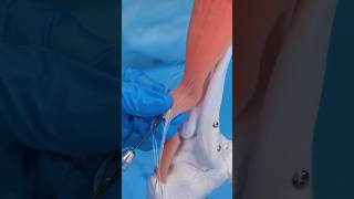 Achilles tendon rupture surgical repair