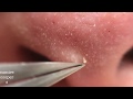 鼻角栓122nose blackheads★tweezers only★