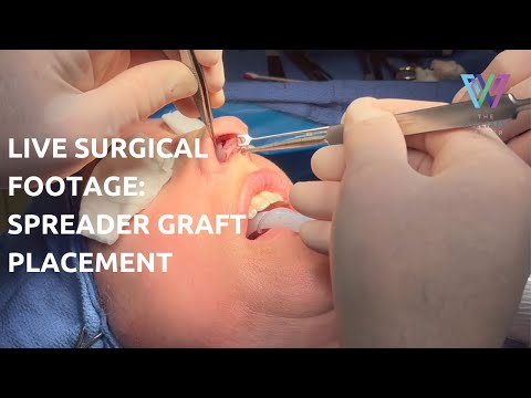 Video thumbnail: Live Rhinoplasty Surgical Footage: Spreader Graft Placement