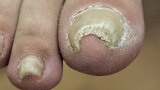 Curvy toenail. Cleaning and cutting.