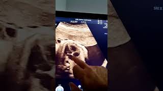 DR. MEHMET BOZ.  FETAL KALP NORMAL YAPISI. GEBELIKTE.