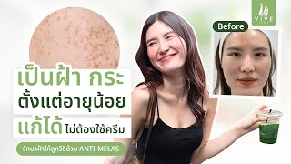 รักษาฝ้า I EP.4 ชอบแต่วหน้าแบบงานผิว แต่ฝ้ากระกวนใจ l The Vive Clinic