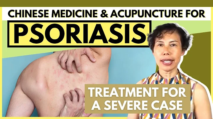 Severe Psoriasis Treatment with Traditional Chinese Medicine | Psoriasis Cure Stories | GinSen - DayDayNews