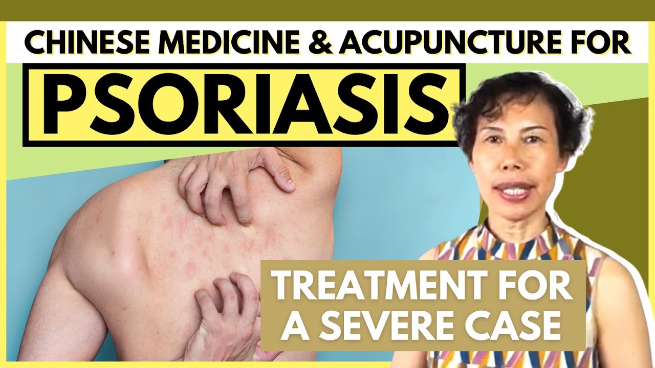 Severe Psoriasis Treatment with Traditional Chinese Medicine ...