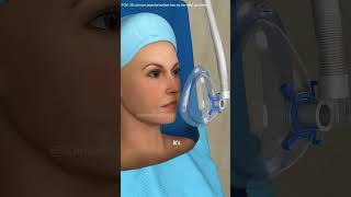 Per Cutaneous Nephrolithotomy Pcnl