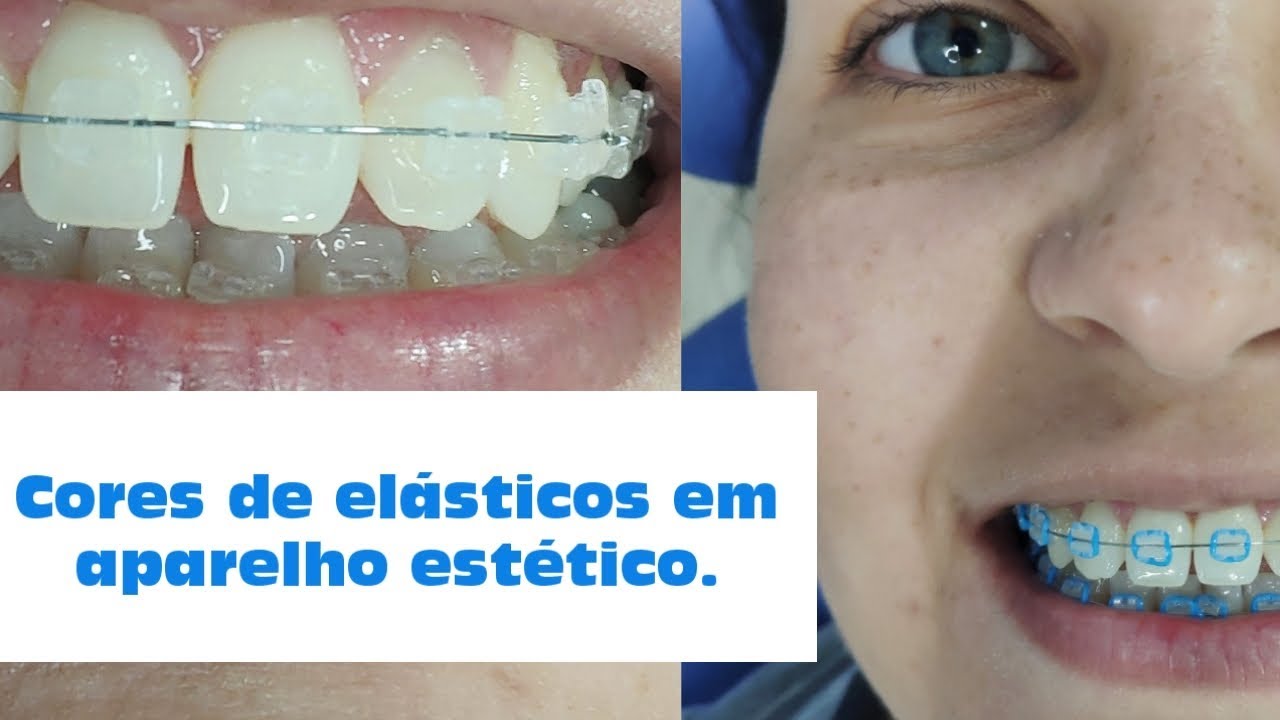 Para Que Serve O Elastico Do Aparelho