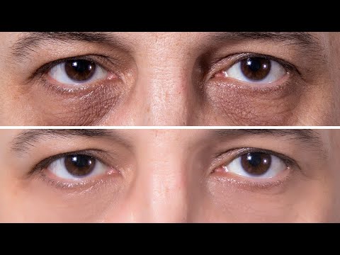 How To Get Rid of Dark Circles Permanently