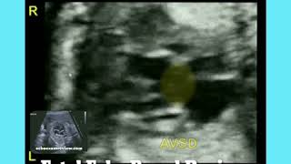 Double Outlet Right Ventricle