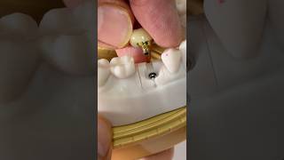 Screw-retained Mini-SYTON ZEN zirconia crown made in my lab for Dr. Sharitha Uchil in Michigan