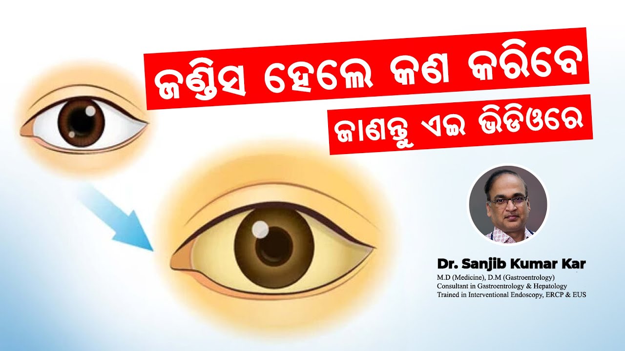 ଜଣ୍ଡିସ ହେଲେ କଣ କରିବେ ଜାଣନ୍ତୁ ଏଇ ଭିଡ଼ିଓରେ || Jaundice Treatment || Dr. Sanjib Kumar Kar