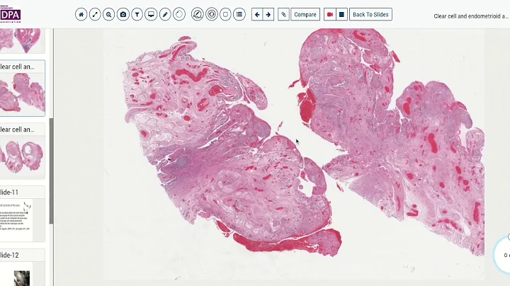 Digital Pathology sign out 27 1 Clear cell carcinoma of the ovary