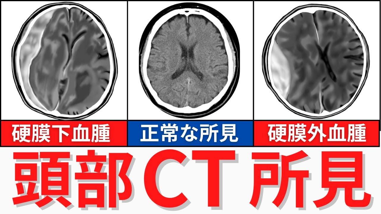 【10分で解説】CT検査の所見について解説