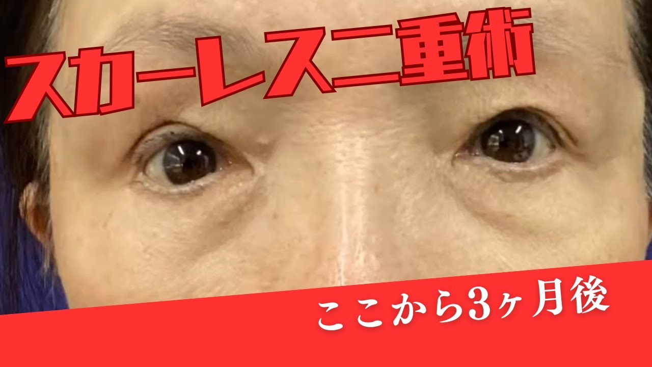 スカーレス二重術で二重修正　３か月／名古屋こいずみ形成クリニック症例集