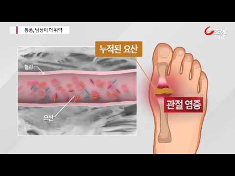 눈물 아리는 통풍…남성이 여성의 10배
