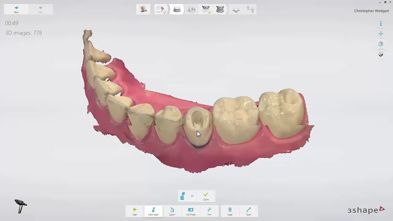 configuração significado 3Shape TRIOS - Fluxo de trabalho para Núcleos Intra-radiculares