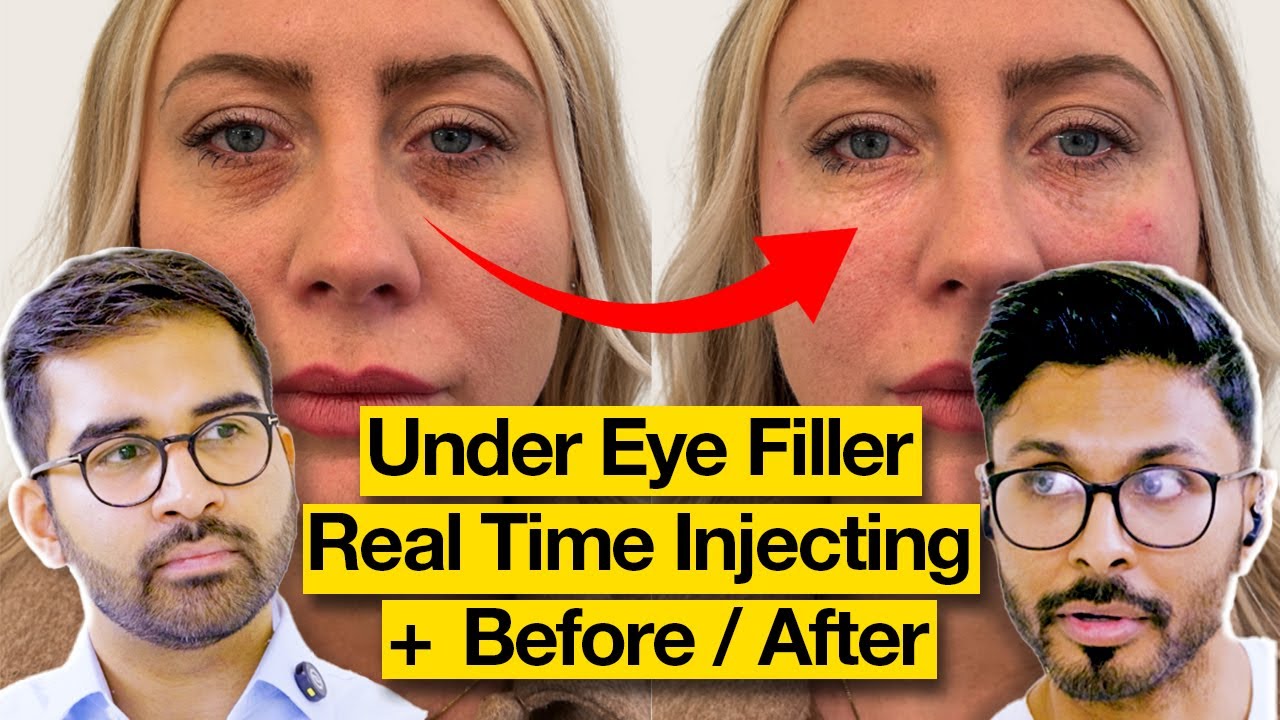 Tear Trough Filler Before & After